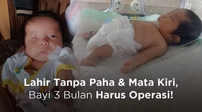 Gambar banner Lahir Tanpa Paha, Bayi Ini Terancam Tak Bisa Jalan